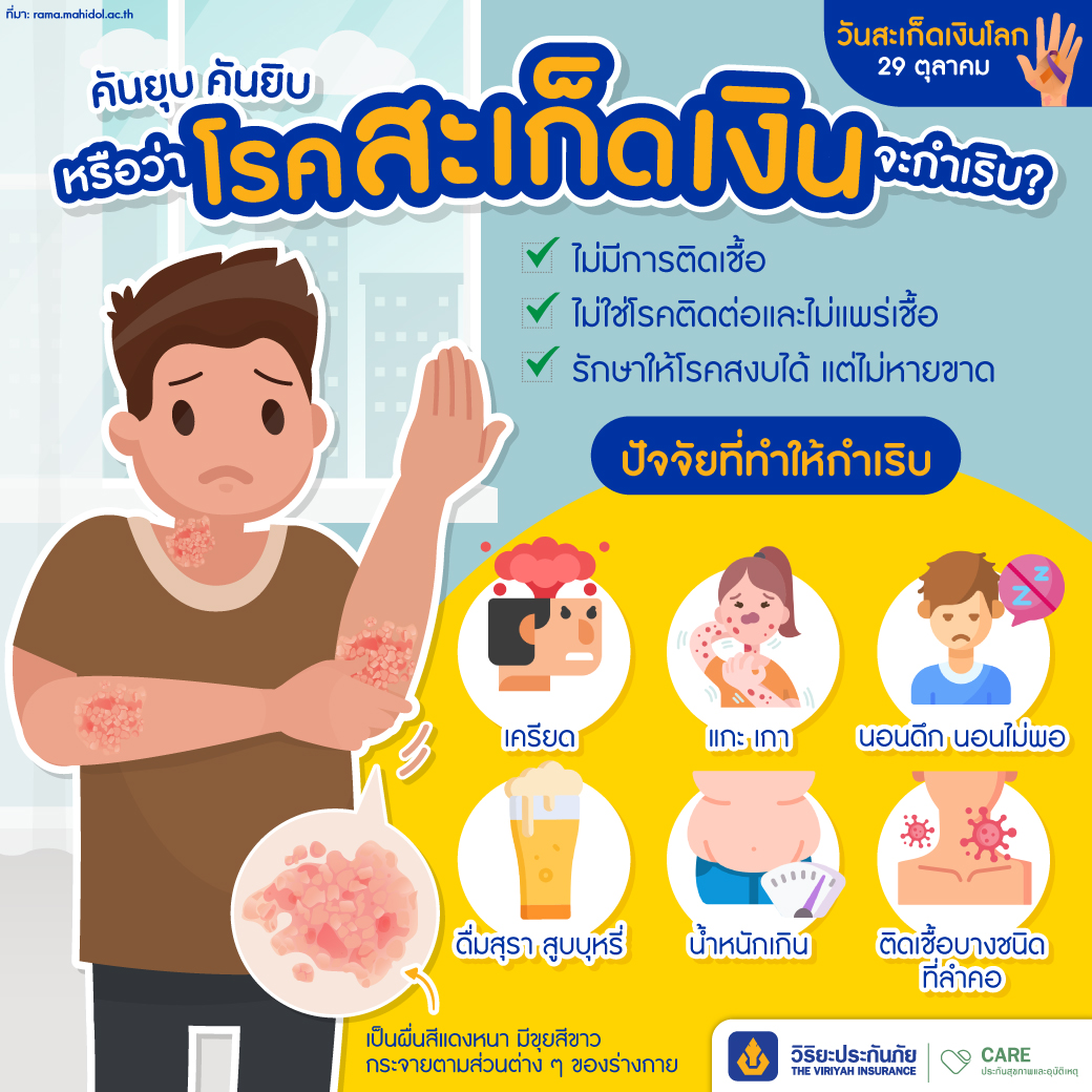 โรคสะเก็ดเงิน