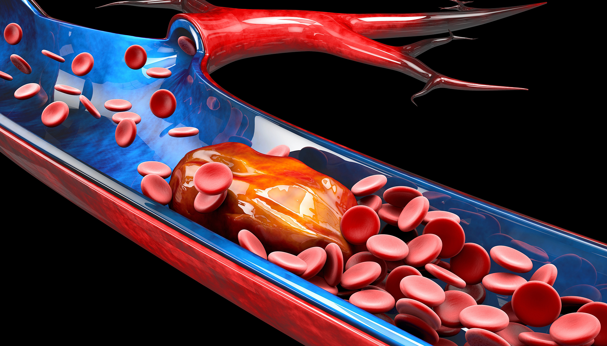 pulmonary-embolism