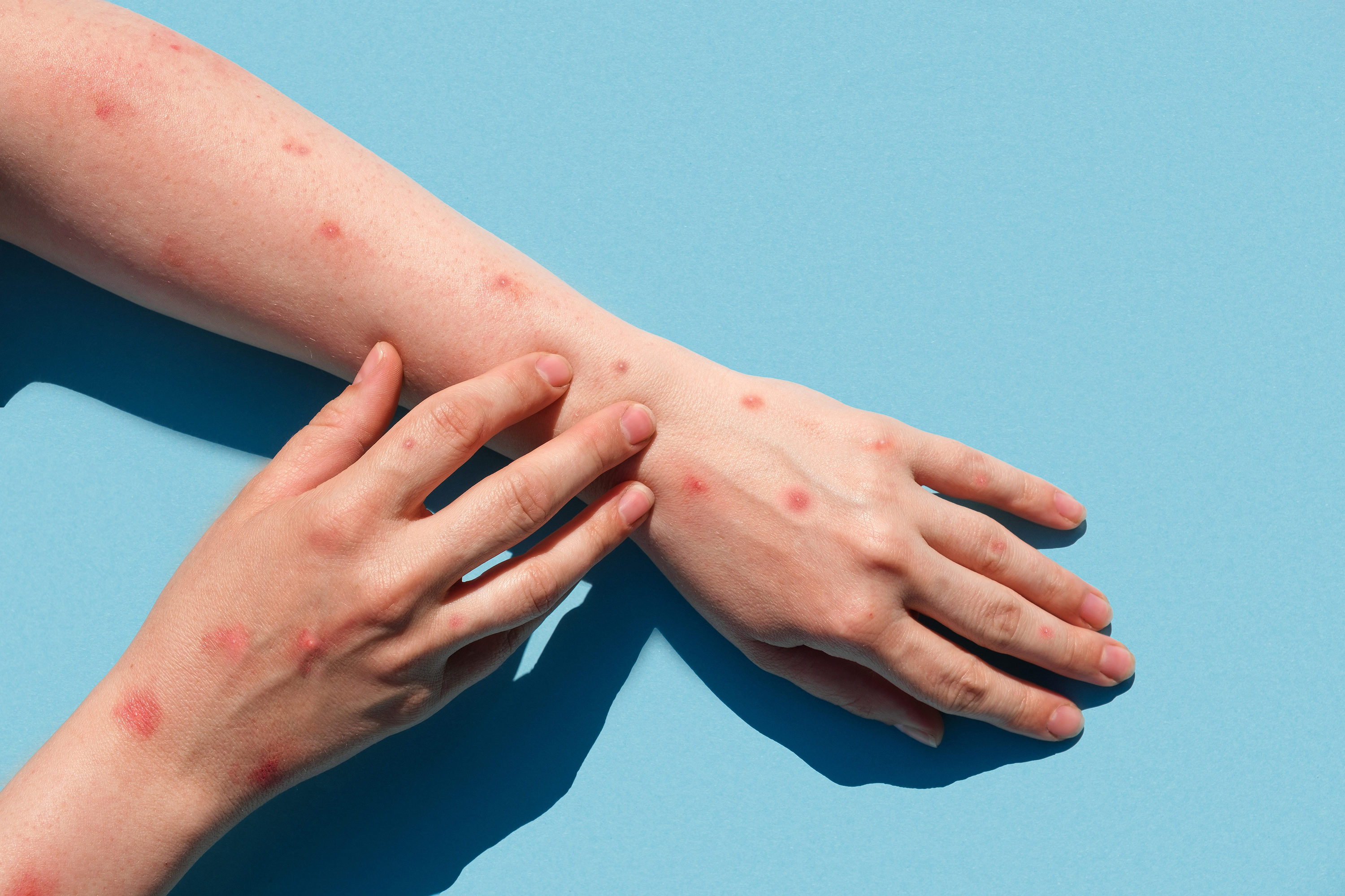 monkeypox-virus