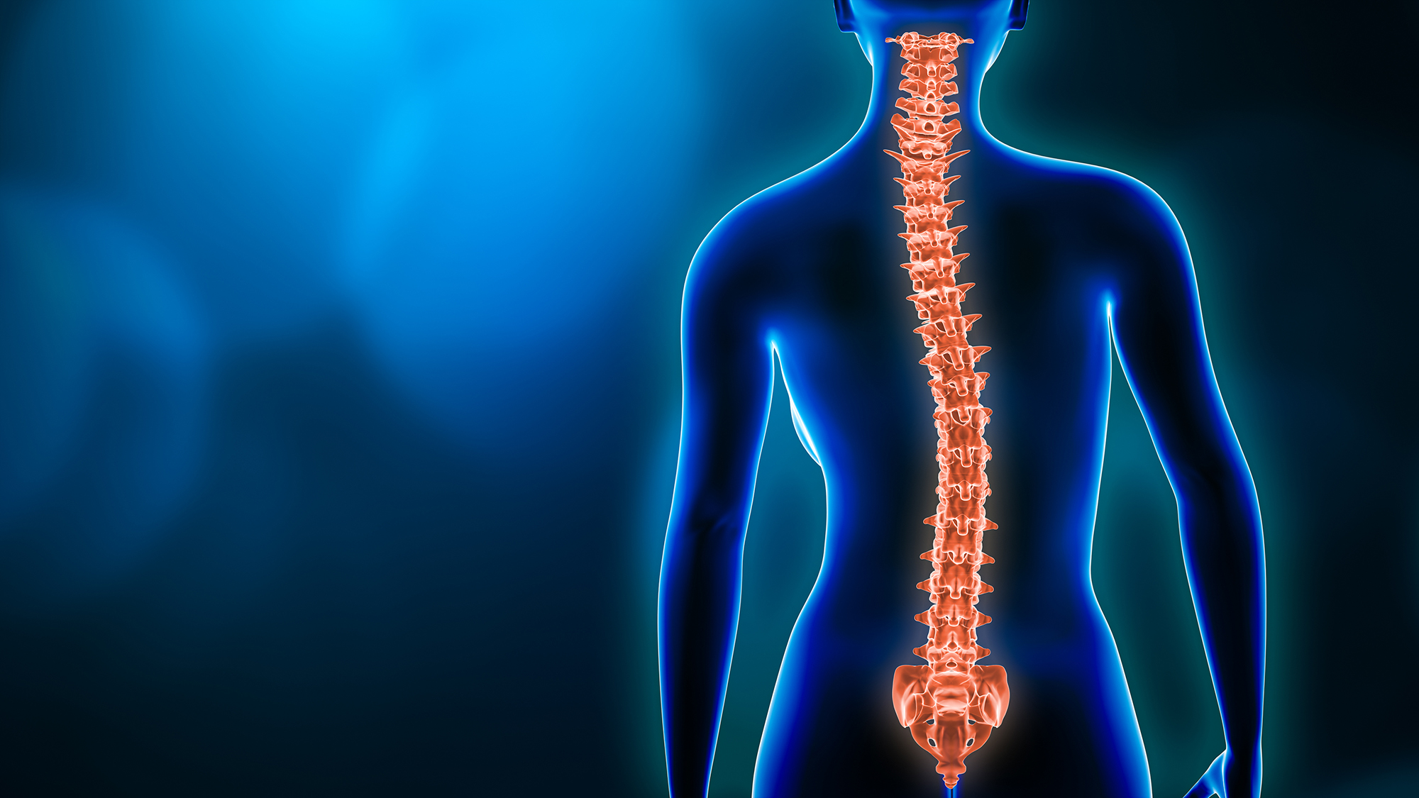 scoliosis